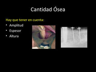 Cantidad Ósea
Hay que tener en cuenta:
• Amplitud
• Espesor
• Altura
 