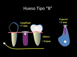 Hueso Tipo “B”
Amplitud
>7 mm
Reborde alveolar conservado
Espesor
>3 mm
Altura
>13mm
 