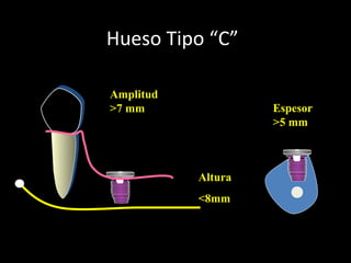 Hueso Tipo “C”
Amplitud
>7 mm
Reborde alveolar conservado
Espesor
>5 mm
Altura
<8mm
 