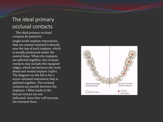 Primaryb Rudge's Implant intruduction misch contemporary implant dentistry Dr fariborz ...