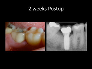 2 weeks Postop
 