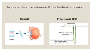 Ocuset Formulation Implantable Drug Delivery Systems – Concepts, Types, and Applications ...