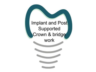 Implant and Post
Supported
Crown & bridge
work

 