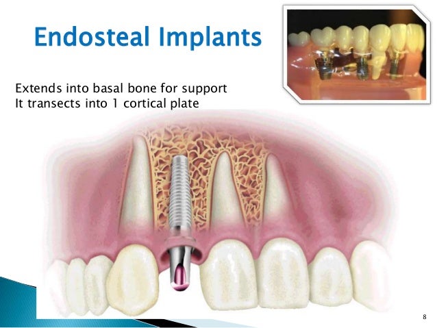 implant armamentarium endosteal implant
