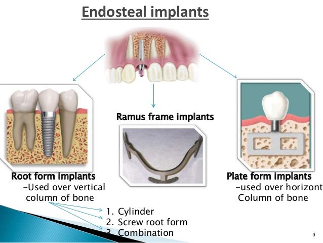 endosteal implant under fontanacountryinn com endosteal implant