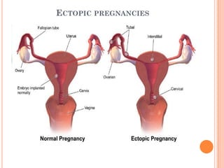 ECTOPIC PREGNANCIES
 