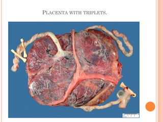 PLACENTA WITH TRIPLETS.
 