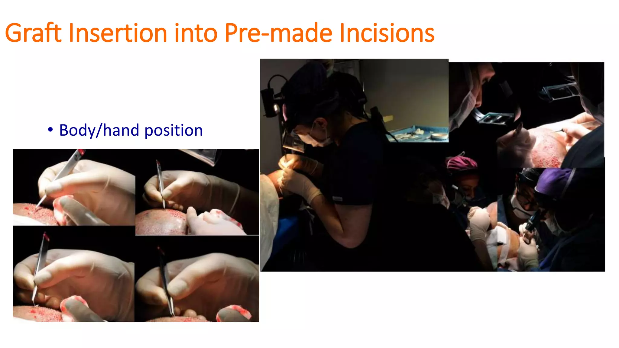 Graft Insertion into Pre-made Incisions
• Body/hand position
 