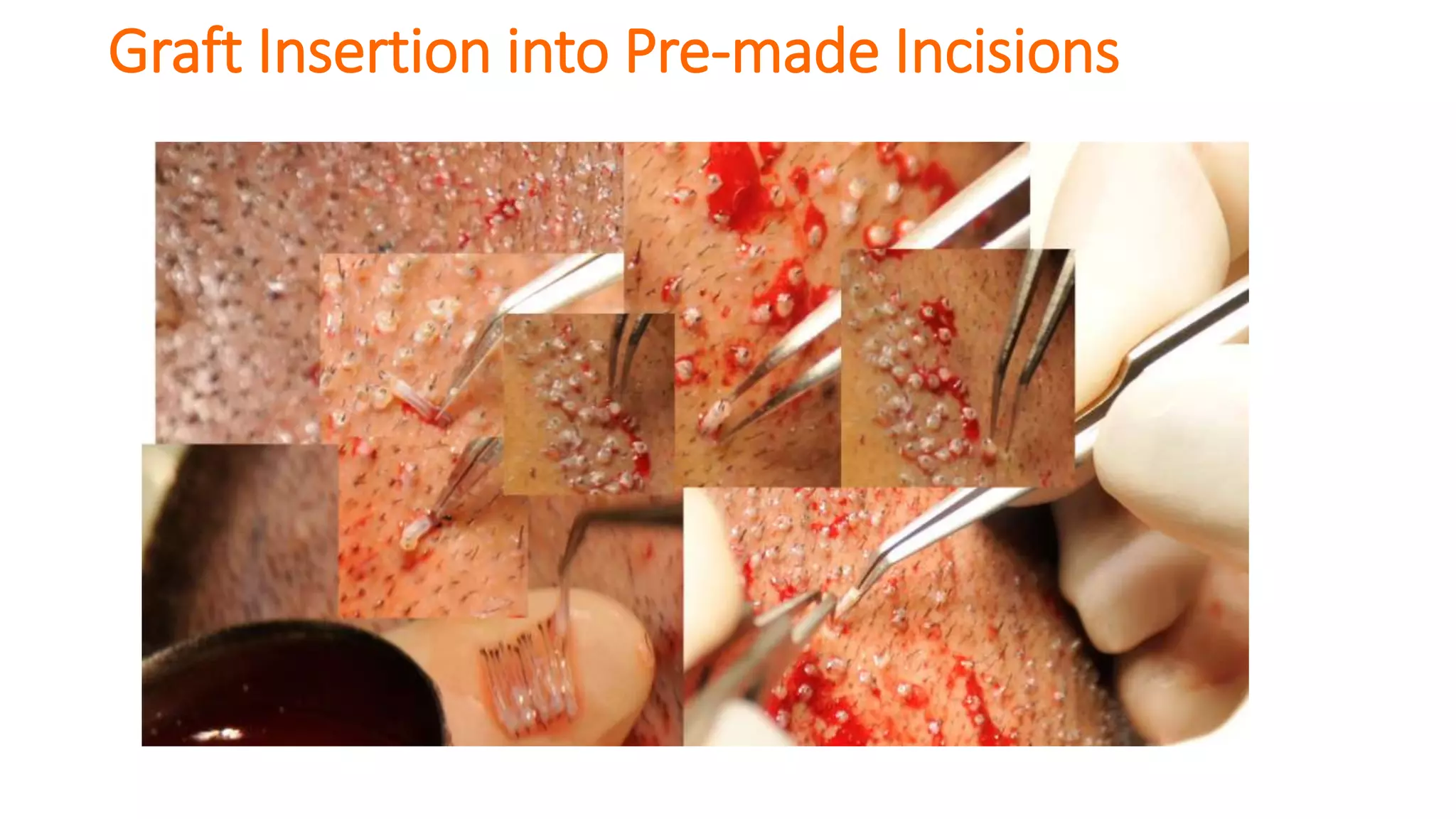 Graft Insertion into Pre-made Incisions
 