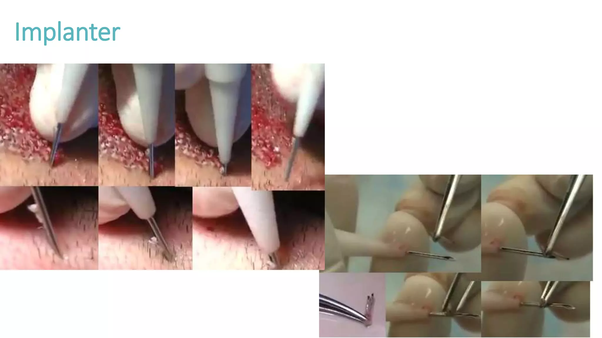 Implanter
 