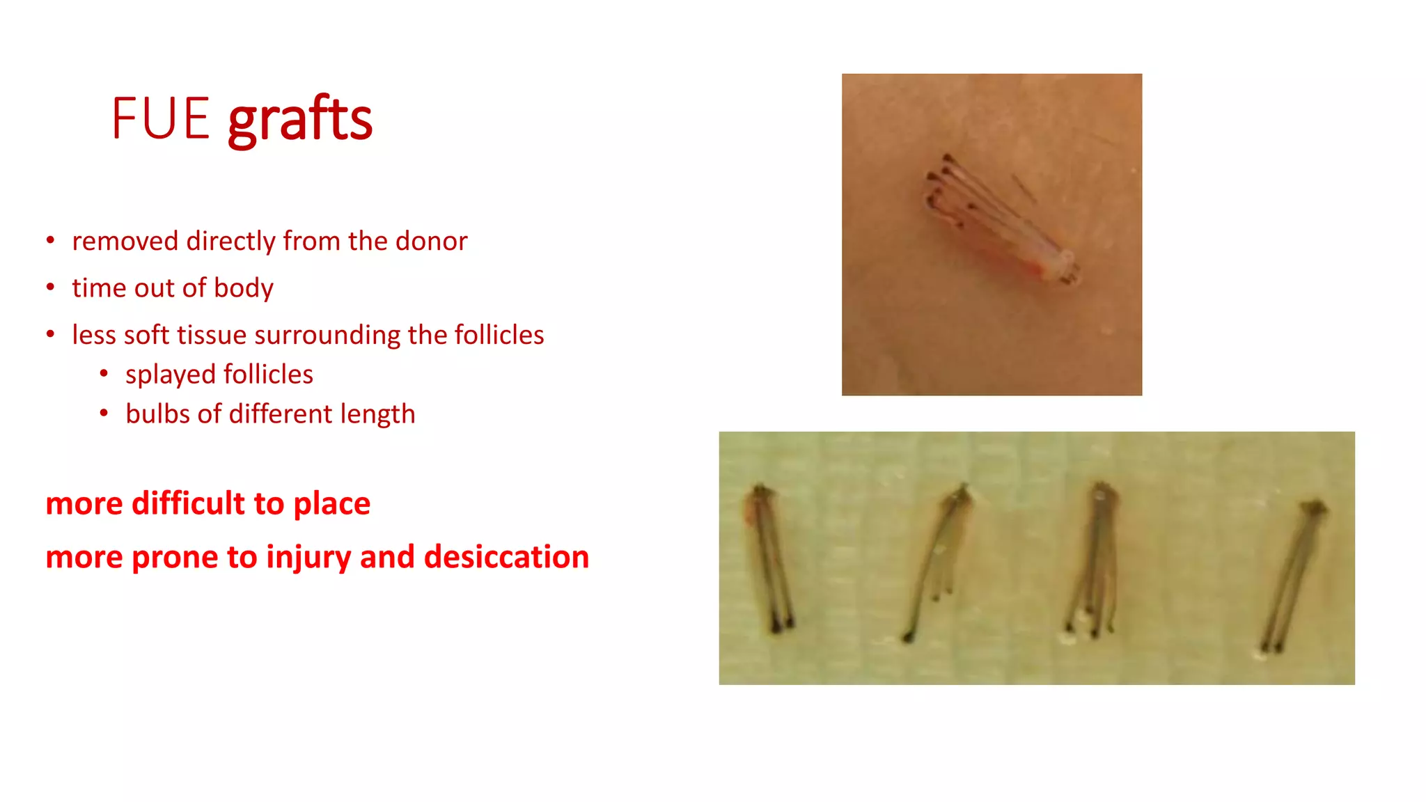 FUE grafts
• removed directly from the donor
• time out of body
• less soft tissue surrounding the follicles
• splayed follicles
• bulbs of different length
more difficult to place
more prone to injury and desiccation
 