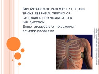 IMPLANTATION OF PACEMAKER TIPS AND
TRICKS ESSENTIAL TESTING OF
PACEMAKER DURING AND AFTER
IMPLANTATION.
EARLY DIAGNOSIS OF PACEMAKER
RELATED PROBLEMS
implantationofpacemakertipsandtricks,essential
testingofpacemaker,earlydiagnosisofpacemaker
complications
 