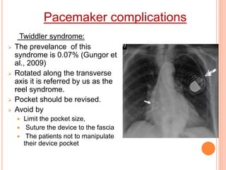 Pacemaker Widdler fundamentals of pacemaker | PPTX