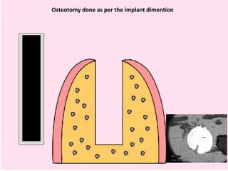 Osteotomy done as per the implant dimention
 