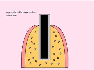 Implant in drill-osteotomised
bone-hole
 