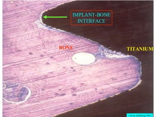 [ Nevins &Mellonig,1998 ]
TITANIUM
BONE
IMPLANT-BONE
INTERFACE
 