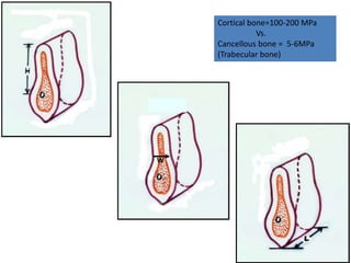 W
Cortical bone=100-200 MPa
Vs.
Cancellous bone = 5-6MPa
(Trabecular bone)
 