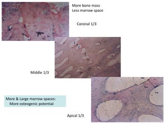 Middle 1/3
Apical 1/3
Coronal 1/3
More & Large marrow spaces:
More osteogenic potential
More bone mass
Less marraw space
 