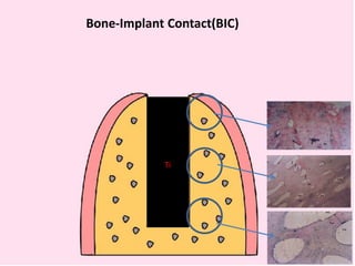 ti Ti
Bone-Implant Contact(BIC)
 