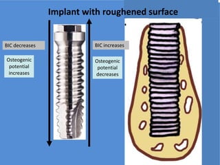 i
BIC decreases BIC increases
Osteogenic
potential
increases
Osteogenic
potential
decreases
Implant with roughened surface
 