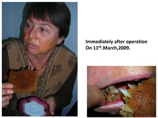 Immediately after operation
On 11th.March,2009.
 