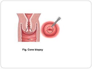 Fig. Cone biopsy
 