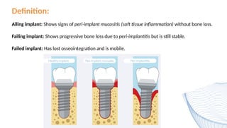 Definition:
Ailing implant: Shows signs of peri-implant mucositis (soft tissue inflammation) without bone loss.
Failing implant: Shows progressive bone loss due to peri-implantitis but is still stable.
Failed implant: Has lost osseointegration and is mobile.
 