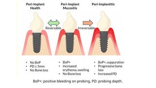 BoP+: positive bleeding on probing, PD: probing depth.
 