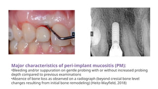 Major characteristics of peri-implant mucositis (PM):
•Bleeding and/or suppuration on gentle probing with or without increased probing
depth compared to previous examinations
•Absence of bone loss as observed on a radiograph (beyond crestal bone level
changes resulting from initial bone remodeling) (Heitz-Mayfield, 2018)
 