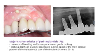 Major characteristics of peri-implantitis (PI):
• presence of bleeding and/or suppuration on gentle probing
• probing depths of 6 mm; bone levels 3 mm apical of the most coronal
≥ ≥
portion of the intraosseous part of the implant (Schwarz, 2018)
 