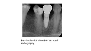Peri-implantitis site 44 on intraoral
radiography.
 