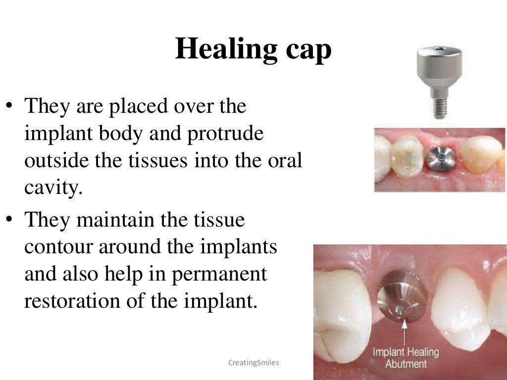 Implant Biomaterials