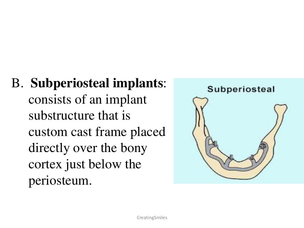 Implant Biomaterials