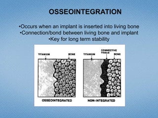 OSSEOINTEGRATION
•Occurs when an implant is inserted into living bone
•Connection/bond between living bone and implant
•Key for long term stability
 