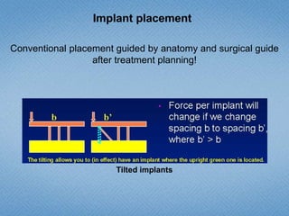 Implant placement
Conventional placement guided by anatomy and surgical guide
after treatment planning!
Tilted implants
 
