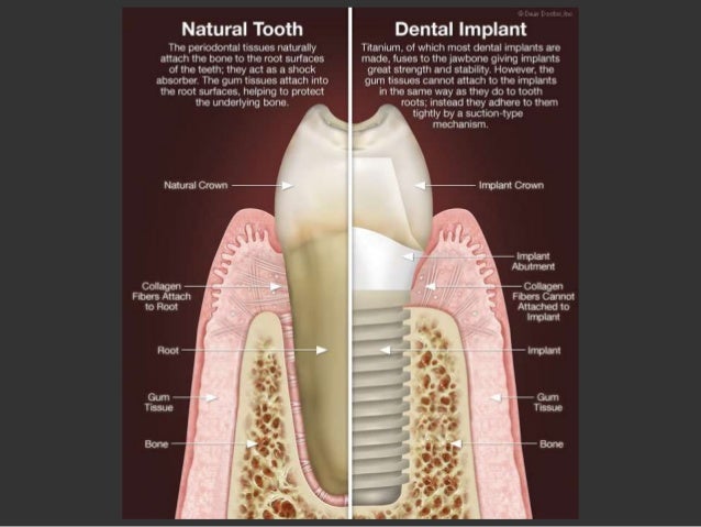 Implant Biomechanics