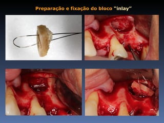 Preparação e fixação do bloco “inlay”
 