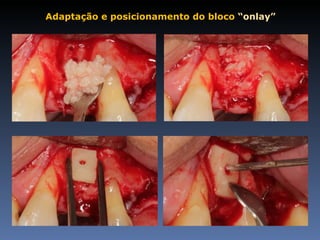 Adaptação e posicionamento do bloco “onlay”
 
