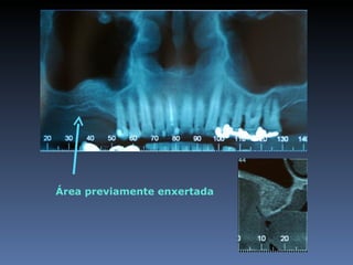 Área previamente enxertada
 