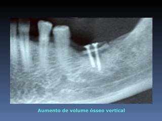 Aumento de volume ósseo vertical
 