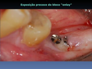 Exposição precoce do bloco “onlay”
 