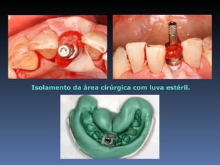 Isolamento da área cirúrgica com luva estéril.
 