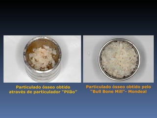 Particulado ósseo obtido       Particulado ósseo obtido pelo
através de particulador “Pilão”     “Bull Bone Mill”- Mondeal
 