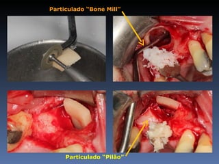 Particulado “Bone Mill”




     Particulado “Pilão”
 