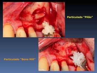 Particulado “Pilão”




Particulado “Bone Mill”
 