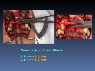 Mensuração pré-reabilitação :

1.1 ------ 3,0 mm
2.1 ------ 3,0 mm
 