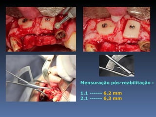 Mensuração pós-reabilitação :

1.1 ------ 6,2 mm
2.1 ------ 6,3 mm
 