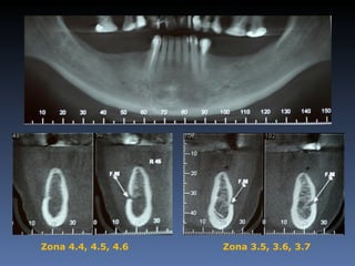 Zona 4.4, 4.5, 4.6   Zona 3.5, 3.6, 3.7
 
