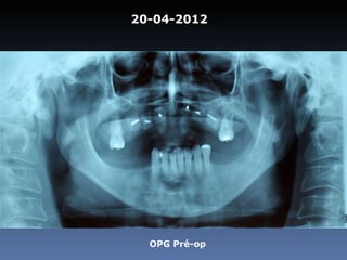20-04-2012




  OPG Pré-op
 