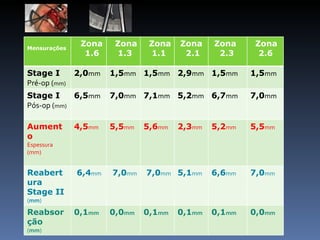 Mensurações
               Zona    Zona    Zona   Zona    Zona     Zona
                1.6    1.3     1.1     2.1     2.3      2.6

Stage I       2,0mm   1,5mm 1,5mm 2,9mm 1,5mm         1,5mm
Pré-op (mm)
Stage I     6,5mm     7,0mm 7,1mm 5,2mm 6,7mm         7,0mm
Pós-op (mm)

Aument        4,5mm   5,5mm   5,6mm   2,3mm   5,2mm   5,5mm
o
Espessura
(mm)


Reabert       6,4mm   7,0mm   7,0mm 5,1mm     6,6mm   7,0mm
ura
Stage II
(mm)

Reabsor       0,1mm   0,0mm   0,1mm   0,1mm   0,1mm   0,0mm
ção
(mm)
 
